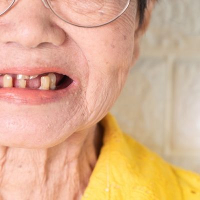 Soulagez vos gencives douloureuses avec des remèdes de grand-mère : des astuces naturelles qui marchent !