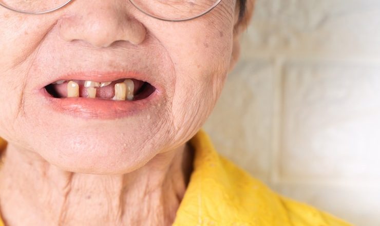 Soulagez vos gencives douloureuses avec des remèdes de grand-mère : des astuces naturelles qui marchent !