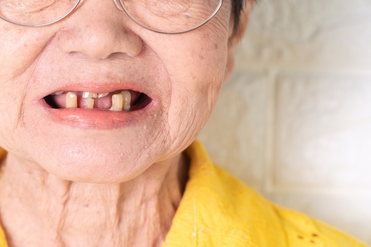 Soulagez vos gencives douloureuses avec des remèdes de grand-mère : des astuces naturelles qui marchent !