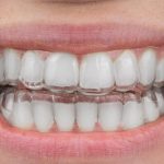 Comment obtenir un sourire éclatant avec le blanchiment dentaire gouttière : tout ce que vous devez savoir !