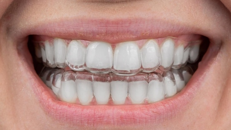 Comment obtenir un sourire éclatant avec le blanchiment dentaire gouttière : tout ce que vous devez savoir !