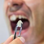 Tout ce que vous devez savoir sur la fausse dent à coller : Le guide ultime pour un sourire au top
