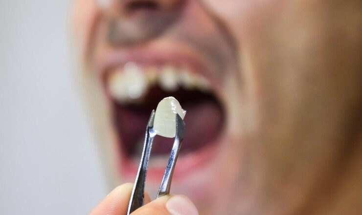 Tout ce que vous devez savoir sur la fausse dent à coller : Le guide ultime pour un sourire au top