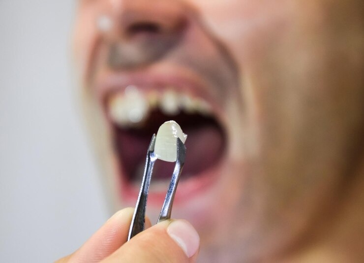 Tout ce que vous devez savoir sur la fausse dent à coller : Le guide ultime pour un sourire au top