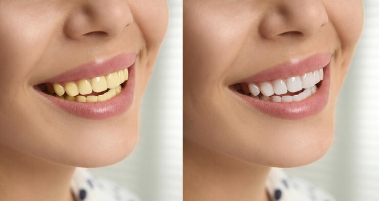 Comment se débarrasser des dents jaunes : un guide complet pour un sourire éclatant