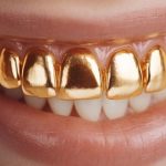 Tout ce que vous devez savoir sur une dent en or