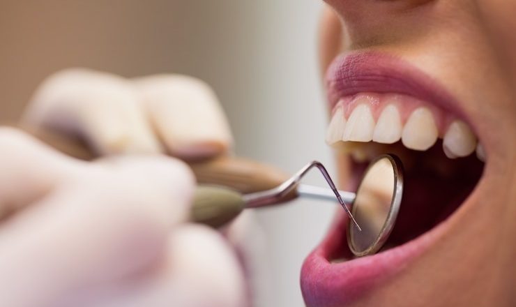 T’as déjà fait un détartrage ? Voici pourquoi c’est un game-changer pour tes dents !