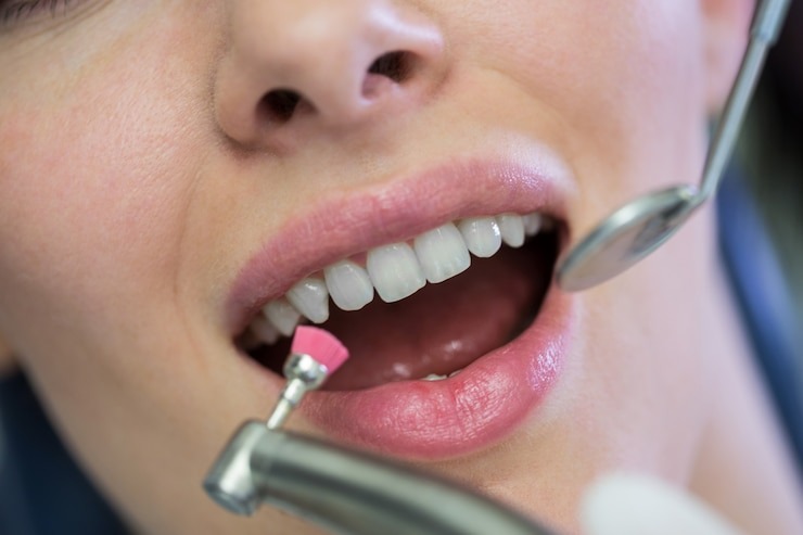 Guide ultime du traitement gencive : comment avoir des gencives en béton et un sourire qui déchire