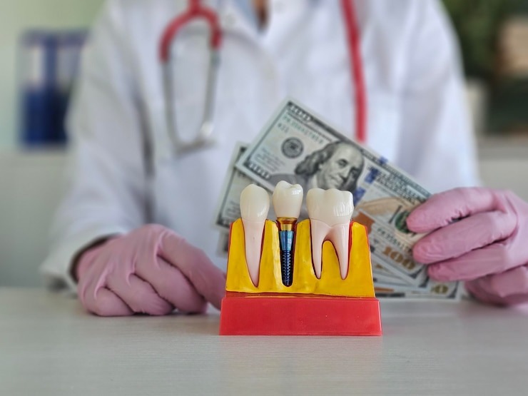 Tout ce que vous devez savoir sur le prix d’une dent sur pivot : Guide complet pour un sourire éclatant