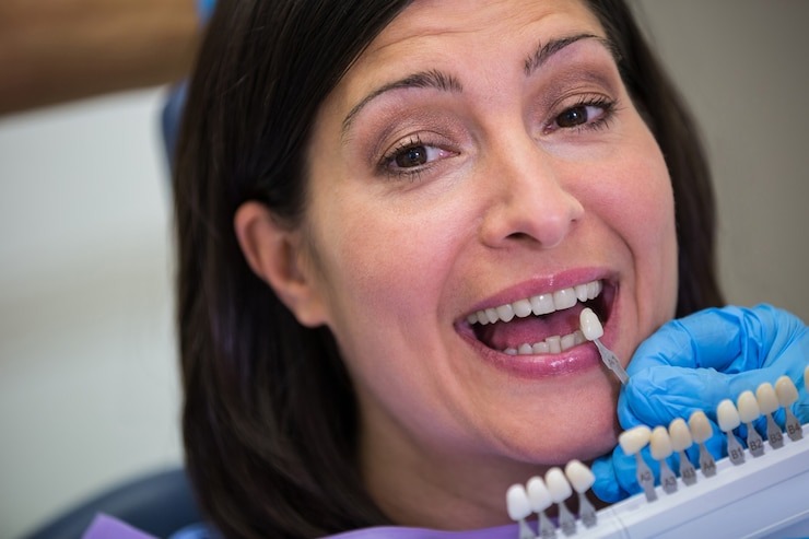 Blanchiment des dents prix : Combien ça coûte pour un sourire éclatant ?
