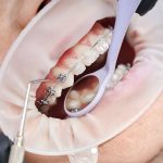 Scelladent : La colle dentaire qui vous sauve la mise en 2025 ?