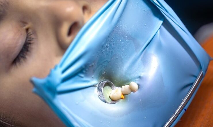 Tout ce que vous devez savoir sur le peroxyde d’hydrogène pour blanchir vos dents : Le guide ultime