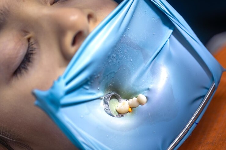 Tout ce que vous devez savoir sur le peroxyde d’hydrogène pour blanchir vos dents : Le guide ultime