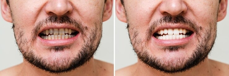 Tout ce que vous devez savoir sur les dents écartées : causes, solutions et astuces