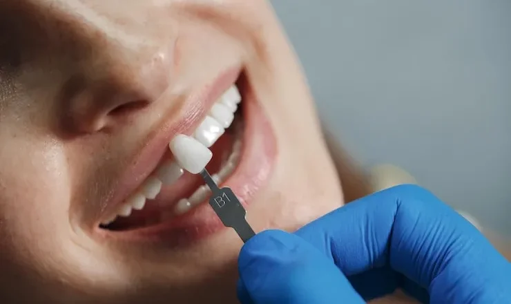 La couronne dentaire : tout ce que tu dois savoir pour garder ton sourire au top