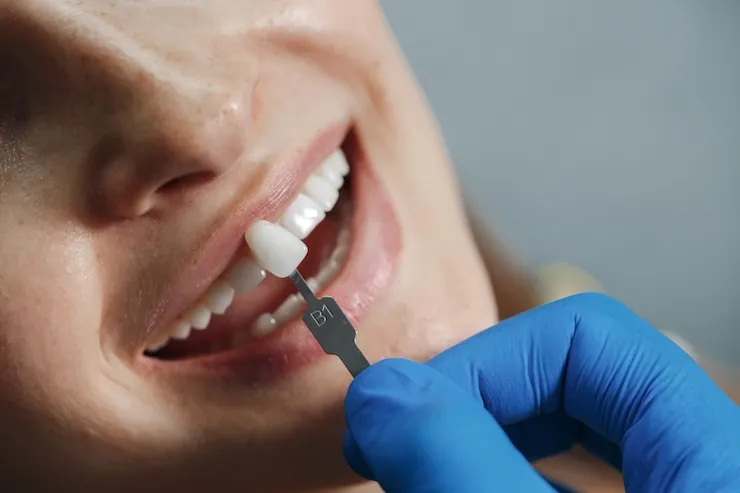 La couronne dentaire : tout ce que tu dois savoir pour garder ton sourire au top