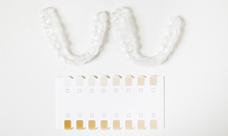 Tout ce que vous devez savoir sur le prix d’un bridge dentaire 6 dents en 2025 : Guide complet pour retrouver votre sourire