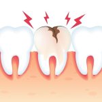 Vous avez peur d’avoir une carie? Voici tout ce qu’il faut savoir!