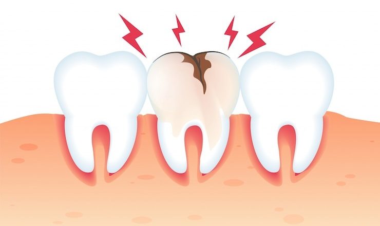 Vous avez peur d’avoir une carie? Voici tout ce qu’il faut savoir!