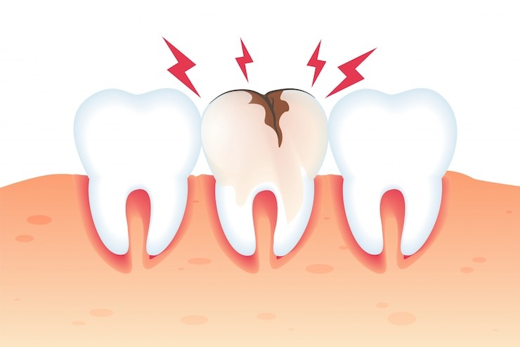 Vous avez peur d’avoir une carie? Voici tout ce qu’il faut savoir!