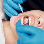 Tout ce que Vous Devez Savoir sur le Plombage Dentaire : Votre Guide Complet pour un Sourire Sans Souci