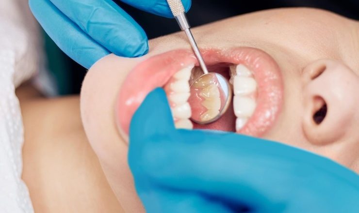 Tout ce que Vous Devez Savoir sur le Plombage Dentaire : Votre Guide Complet pour un Sourire Sans Souci