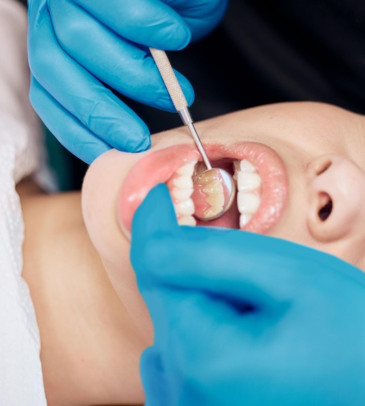Tout ce que Vous Devez Savoir sur le Plombage Dentaire : Votre Guide Complet pour un Sourire Sans Souci