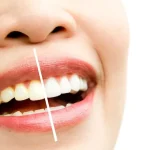 Blanchisseur de Dents : Le Guide Complet pour un Sourire Éclatant