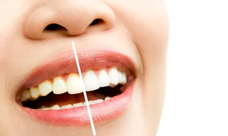 Blanchisseur de Dents : Le Guide Complet pour un Sourire Éclatant