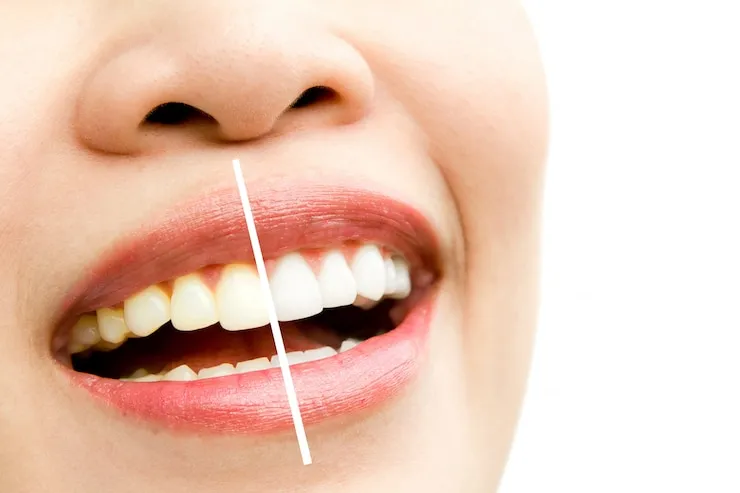Blanchisseur de Dents : Le Guide Complet pour un Sourire Éclatant