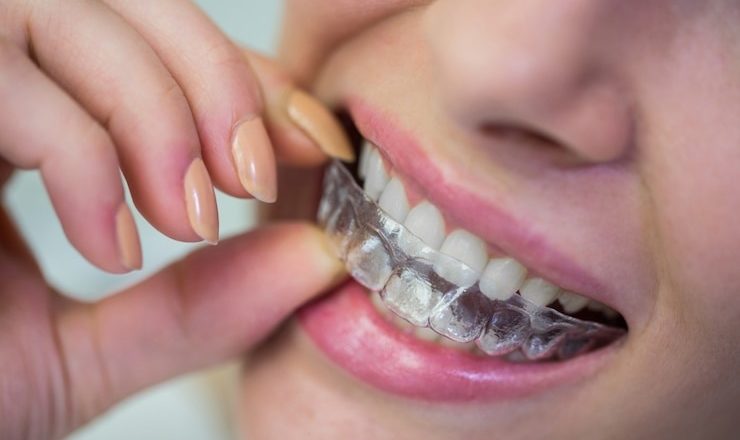 Vous rêvez d’un sourire éclatant ? Découvrez tout sur la gouttière blanchiment dentaire !