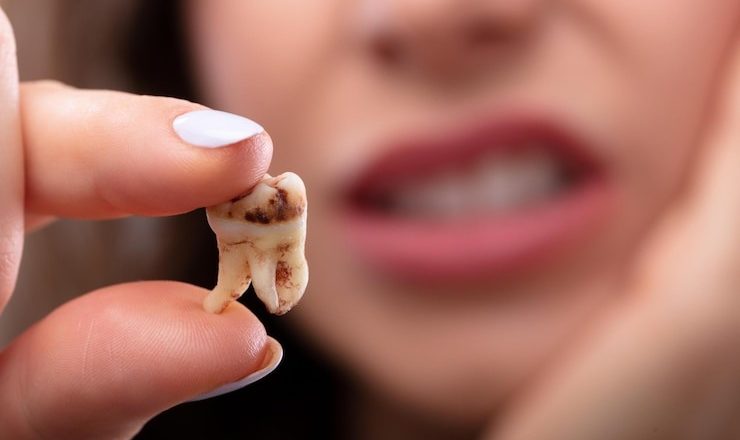 Tout ce que vous devez savoir sur une carie dentaire