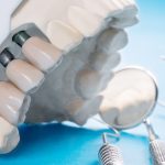Pivot dentaire : Tout ce que vous devez savoir pour comprendre et gérer ce phénomène