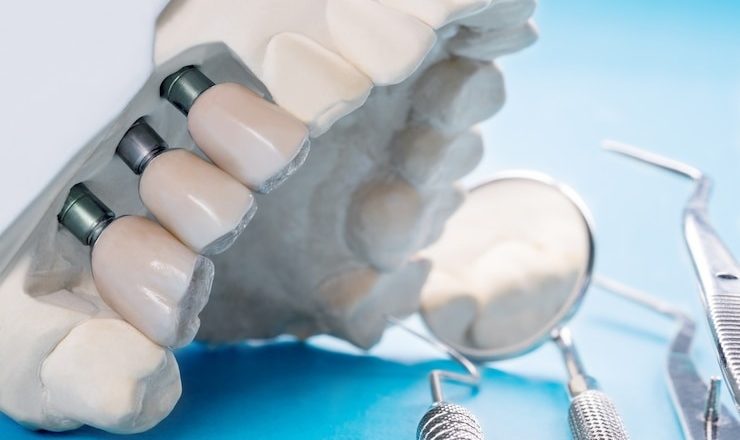 Pivot dentaire : Tout ce que vous devez savoir pour comprendre et gérer ce phénomène