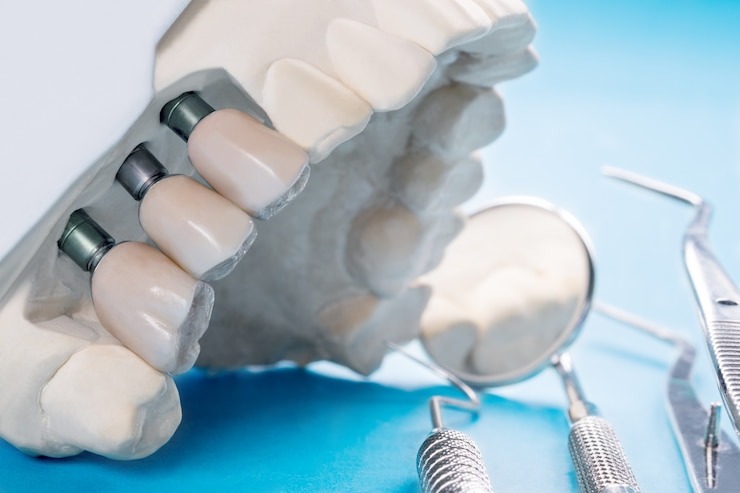 Pivot dentaire : Tout ce que vous devez savoir pour comprendre et gérer ce phénomène