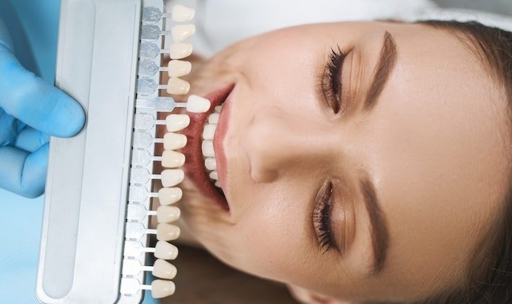 Comment transformer votre sourire avec e.max dentaire : le guide ultime pour un sourire éclatant
