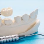 Dent artificielle : Tout ce que vous devez savoir pour retrouver un sourire de star