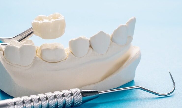 Dent artificielle : Tout ce que vous devez savoir pour retrouver un sourire de star
