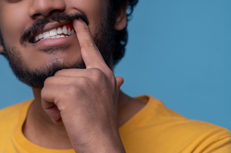 Parodontie : Comment sauver tes dents et ton sourire ?