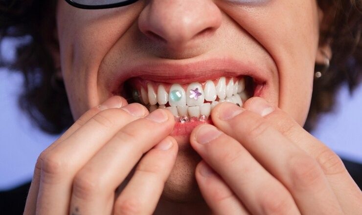 Tout ce que vous devez savoir sur la fausse dent à poser soi même : Votre guide pour un sourire au top sans vous ruiner