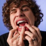 Se refaire les dents : Comment transformer ton sourire en un clin d’œil ?