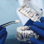 Zircon dentaire : Le secret d’un sourire parfait ou juste un buzz esthétique ?