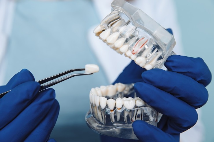 Zircon dentaire : Le secret d’un sourire parfait ou juste un buzz esthétique ?