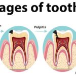 Comment prendre soin de vos dents pour éviter une dent cariée et garder un sourire éclatant