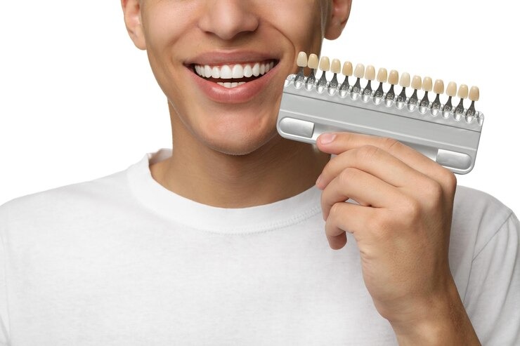 Combien coûtent les facettes dentaires ? Tout ce que vous devez savoir sur le prix facette