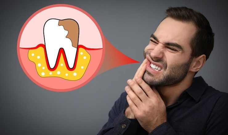 Comment Soigner une Carie : Votre Guide Ultime pour un Sourire Sans Douleur
