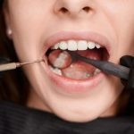 T’as une carie ? Tout ce qu’il faut savoir sur le traitement des caries dentaires