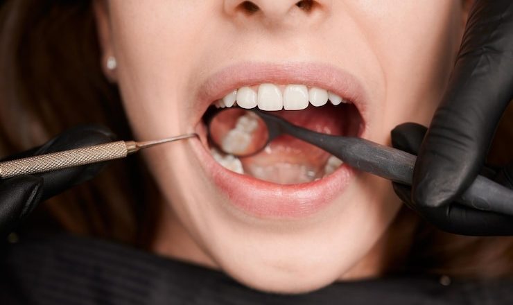 T’as une carie ? Tout ce qu’il faut savoir sur le traitement des caries dentaires