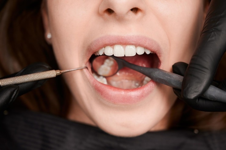 T’as une carie ? Tout ce qu’il faut savoir sur le traitement des caries dentaires