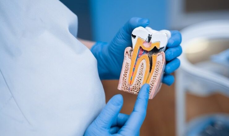 Guide complet pour tout savoir sur le plombadent : votre sourire mérite le meilleur